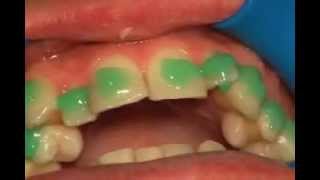 Gluing dental Braces [upl. by Eelame]