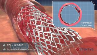 3D Medical Animation of Coronary Stent Procedure [upl. by Maida]