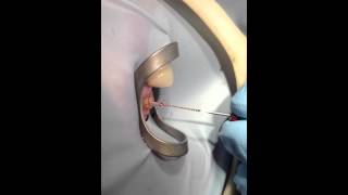 Dental Tooth Nerve removed live from Patient [upl. by Bruning]