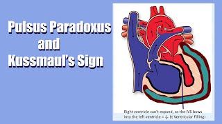 Pulsus Paradoxus amp Kussmauls Sign A Sign of Heart Trouble A Live Lecture [upl. by Idroj]