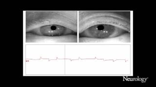 Alternating horizontal single saccadic pulses in progressive supranuclear palsy [upl. by Auqinihs]