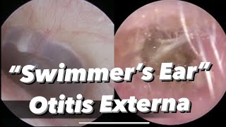 Otitis Externa  Swimmers Ear  infection of the outer ear ear canal [upl. by Perkins]