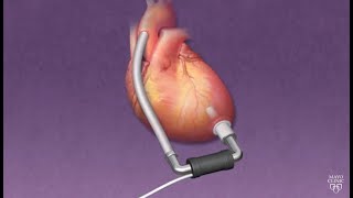 Mayo Clinic Minute How ventricular assist devices can help heart patients [upl. by Allekim583]