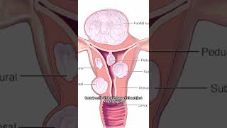 Uterine Polyp vs Fibroids [upl. by Woodward]