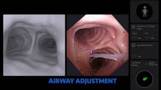 Robotic bronchoscopy amp Proning Technique [upl. by Marco612]