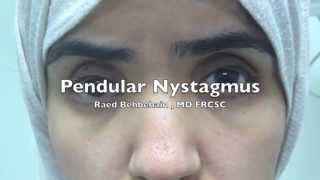 Pendular Nystagmus [upl. by Huldah510]