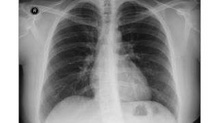 Chest xray Horizontal Fissure [upl. by Gallager]