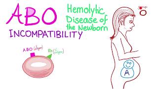 ABO Incompatibility  Hemolytic Disease Of The Newborn HDN  Hematology amp Pathology [upl. by Kassia]