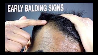 How To Know if Youre Going Bald  Signs of Male Pattern Baldness [upl. by Lladnar527]