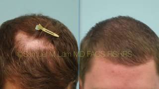 Dallas Hair Transplant for Scarring Alopecia LPP [upl. by Kwan297]