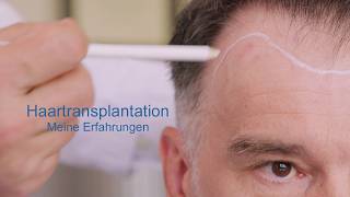 Meine Haartransplantation Erfahrungen  Erfahrungsbericht zur Haarverpflanzung bei Geheimratsecken [upl. by Jamnis]