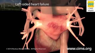 Effects of Congestive Heart Failure  CIMS Hospital [upl. by Jary926]