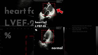 हार्ट पम्पिंग का कम होना What Does Heart Failure Look Like on an Echo [upl. by Atnwahs]