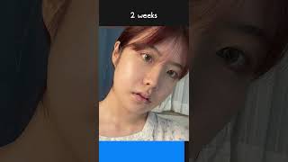 Double Jaw Surgery in Korea Before amp After 3 months post op [upl. by Nannie660]