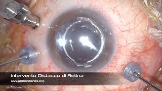 Intervento Distacco di Retina operazione distacco di retina  Dr Abbondanza [upl. by Nacim]