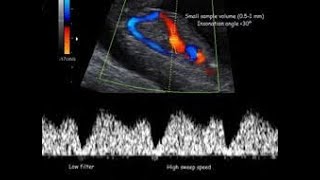 Ductus Venosus  Ultrasound [upl. by Ilohcin]