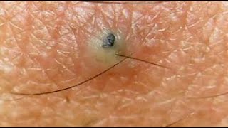 Unusual types of Cysts Eruptive Vellus Hair Cysts this week [upl. by Asilehc969]