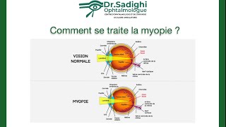 CHIRURGIE REFRACTIVE • Les techniques laser PKR LASIK RELEX SMILE • DR SADIGHI [upl. by Ramu]