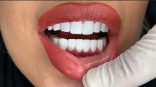 Dental Teeth Smile Design Makeover [upl. by Airdnna245]