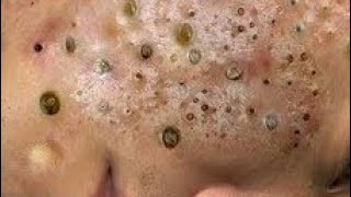 Huge blackhead removal from face  blackheads new this week 2024 [upl. by Aeneas]