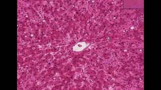 Histopathology Liver Amyloidosis [upl. by Ahsekel889]