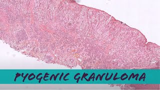 Pyogenic granuloma under the microscope lobular capillary hemangioma pathology dermatology [upl. by Richmal871]