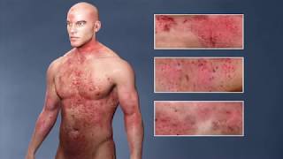 Atopic Dermatitis eczema From the Inside Out [upl. by Rocher]