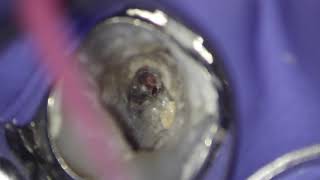 MTA repair of a lateral root perforation [upl. by Berns]