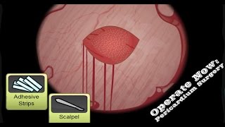 Operate Now Hospital Surgeon Walkthrough [upl. by Labotsirc]