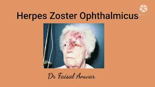 Herpes Zoster Ophthalmicus II Hutchinsons sign II Postherpetic Neuralgia [upl. by Hose]