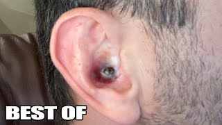 Top 10 Ear Pops Ear Blackheads Pimples Zits and Acne Popping Popaholics [upl. by Anitel693]