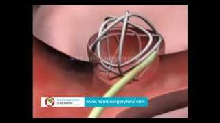 Cerebral Aneurysm Repair in Hyderabad  Aneurysm Coiling Surgery in India [upl. by Balduin]