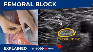 UltrasoundGuided Femoral Nerve Block  Regional anesthesia Crash course with Dr Hadzic [upl. by Akener]