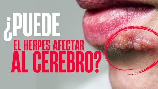 ¿El HERPES puede afectar al CEREBRO ENCEFALITIS HERPÉTICA [upl. by Nevanod366]