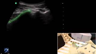 How To Ultrasound Guided Sacroiliac Injection  Sonosite Ultrasound 3D Video [upl. by Tychon]