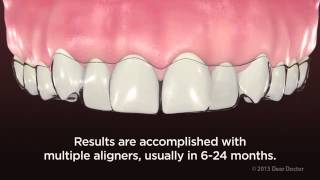 ClearPath Aligners  NEW VIDEO for PATIENT EDUCATION by AACD [upl. by Prochoras]