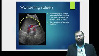 ABDOMINAL USG SPLENOMEGALY AND CONGENITAL VARIANTS [upl. by Thurnau]