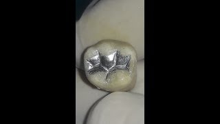 Amalgm restoration for mandibular first molar [upl. by Dara819]