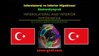 Ekokardiyografi  İnferolateral Ve İnferior Hipokinezi [upl. by Lebana]