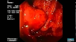 Endotherapy of Gastric Fundal Varices IntraVariceal Injection of NButyl2Cyanoacrylate [upl. by Niel218]