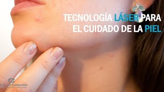 Tecnología láser para quitar manchas en la piel [upl. by Redvers58]