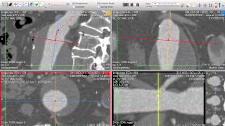 EVAR Planning  Centerline for Aortic amp Total Length  How I do it with Osirix [upl. by Anderson]