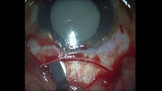 MSICS white cataract Soosan Jacob with audio 2 45 min [upl. by Cryan]