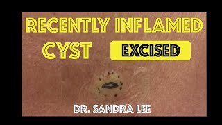 Recently inflamed cyst on the back excised [upl. by Molton390]