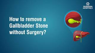 How to remove Gallbladder Stone without surgery [upl. by Arrol]