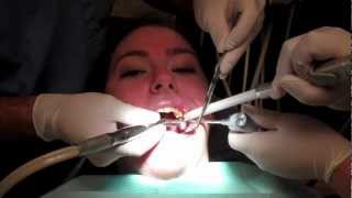 What Is It Like To Get A Filling In Your Tooth With Footage From The Dentists Office [upl. by Skyla]