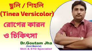 ছুলি বা শিহলি রোগের কারণ ও চিকিৎসা Causes and treatment of Pityriasis Versicolor [upl. by Schwejda]