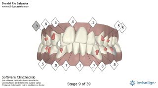 Clincheck Invisalign  Vídeo en 3D [upl. by Enrica368]