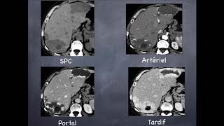 Tumeurs du foie  Bénignes  3 Hémangiome hépatique [upl. by Adiana]