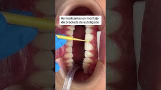 Anímate a iniciar tu tratamiento de ortodoncia con brackets de autoligado 💙 [upl. by Whitman972]